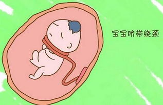 东莞虎门怀孕6个月脐带绕颈一周怎么办?